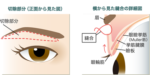 眼瞼下垂(まぶたが重い、開けにくい) | ヴィヴェンシアクリニック