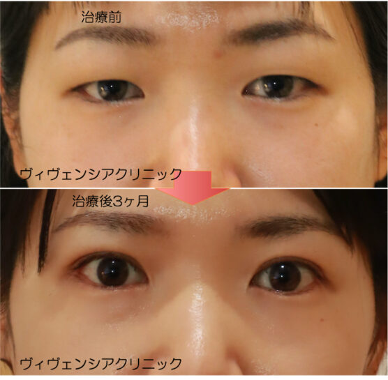 眼瞼下垂(まぶたが重い、開けにくい) | ヴィヴェンシアクリニック