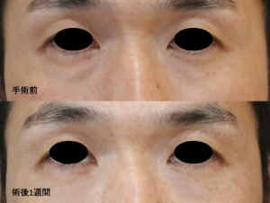 経結膜的下眼瞼脱脂手術用例